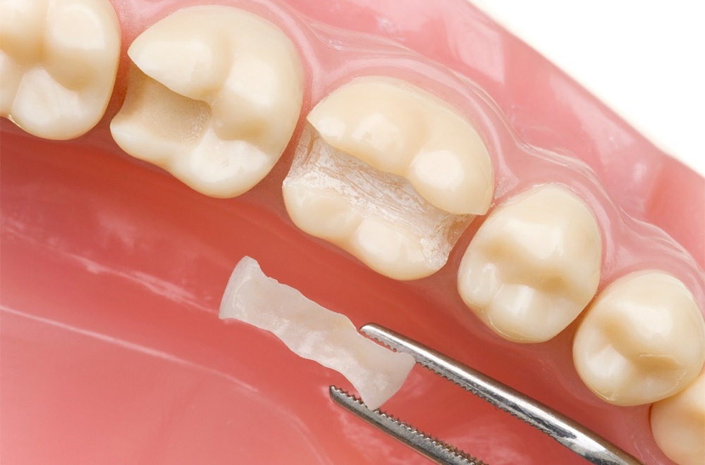 اوژنول در دندانپزشکی